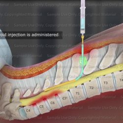 Spinalkanalstenose epidural transforaminal procedure steroid spinalkanal dorsal anestesia mri anesthesie symptome espina puncture verengt vértebras epidurale tussen toont stekel procedimiento