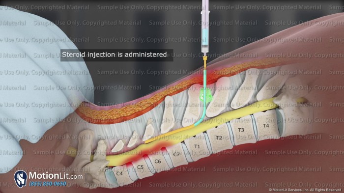 Spinalkanalstenose epidural transforaminal procedure steroid spinalkanal dorsal anestesia mri anesthesie symptome espina puncture verengt vértebras epidurale tussen toont stekel procedimiento