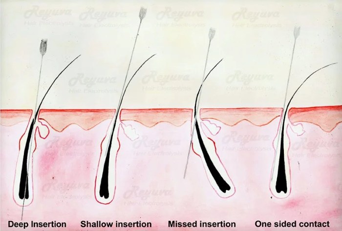 How does thermolysis destroy hair follicles milady